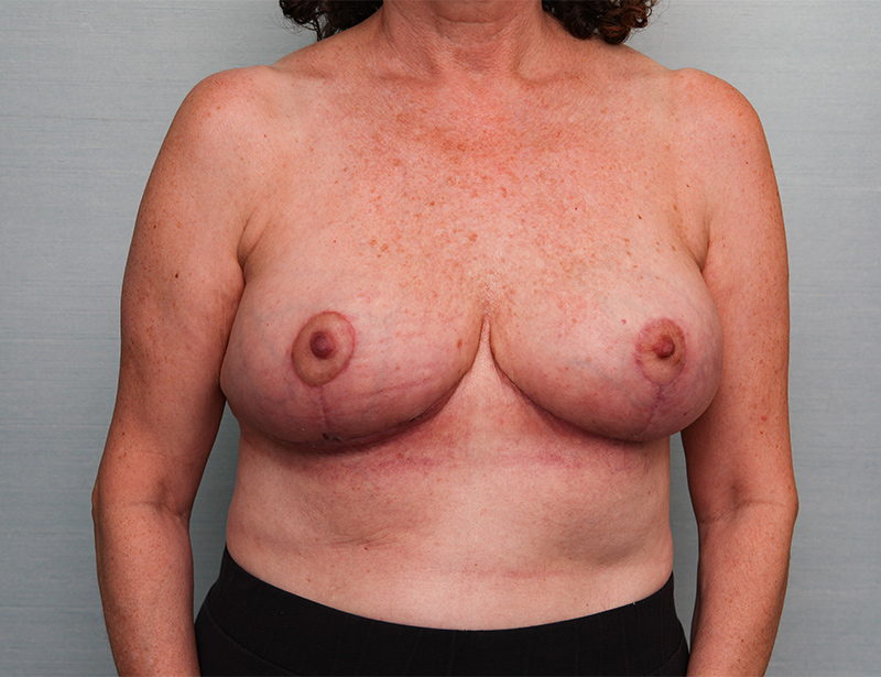 Breast Reduction Before & After Patient Photo