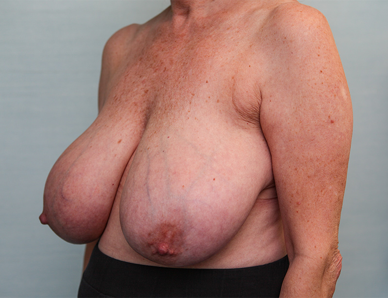 Breast Reduction Before & After Patient Photo