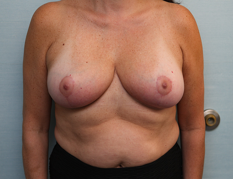 Breast Reduction Before & After Patient Photo