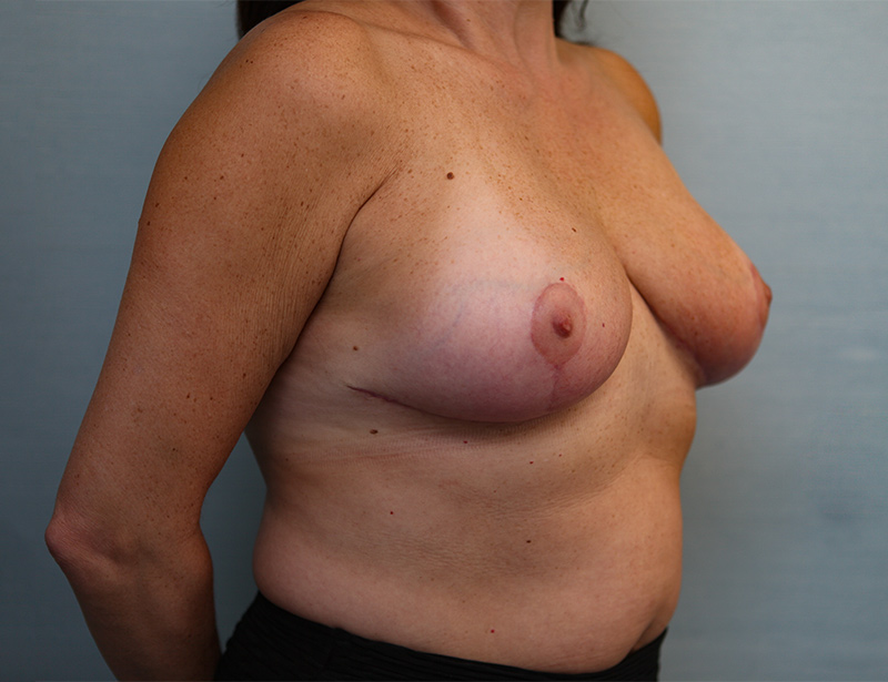 Breast Reduction Before & After Patient Photo