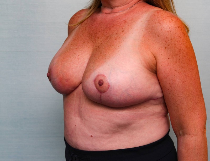 Breast Reduction Before & After Patient Photo