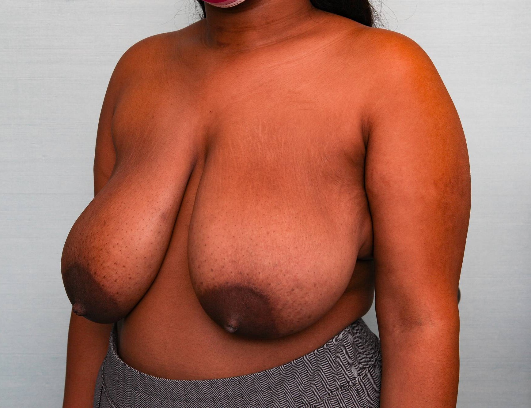 Breast Reduction Before & After Patient Photo