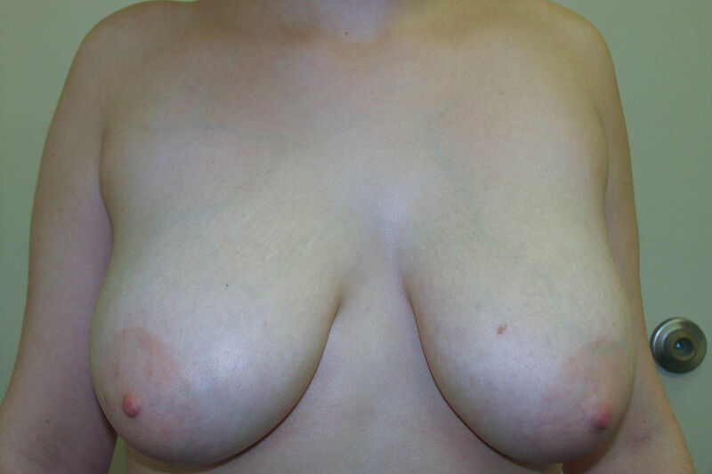 Breast Reduction Before & After Patient Photo