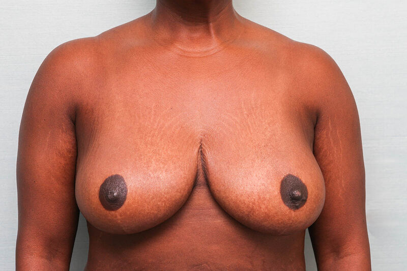 Breast Reduction Before & After Patient Photo