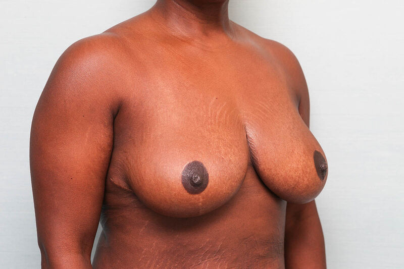 Breast Reduction Before & After Patient Photo