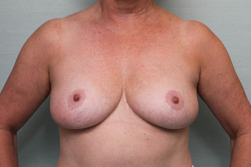 Breast Reduction Before & After Patient Photo