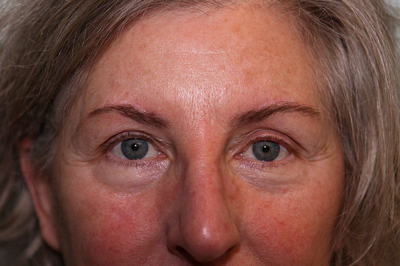 Brow Lift Before & After Patient Photo