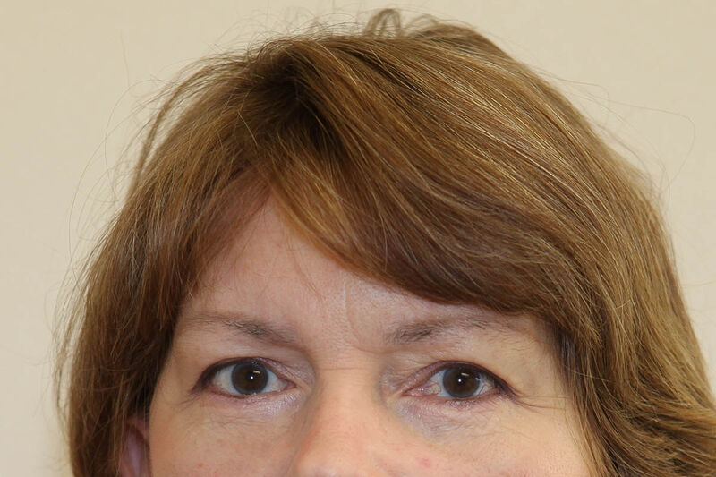 Brow Lift Before & After Patient Photo