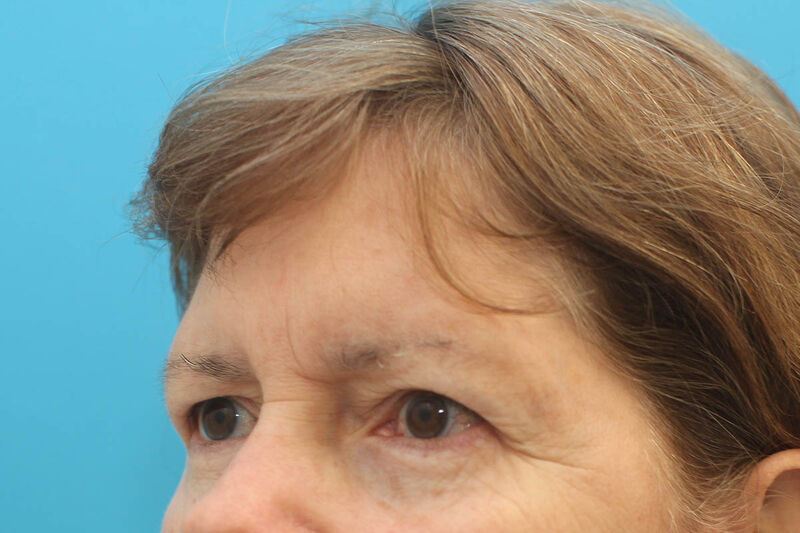 Brow Lift Before & After Patient Photo