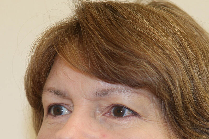 Brow Lift Before & After Patient Photo