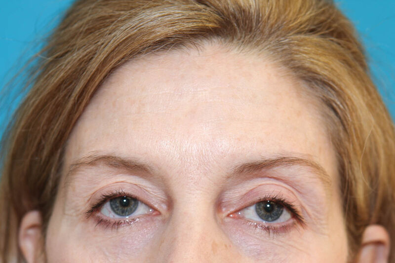 Brow Lift Before & After Patient Photo