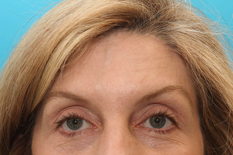 Brow Lift Before & After Patient Photo