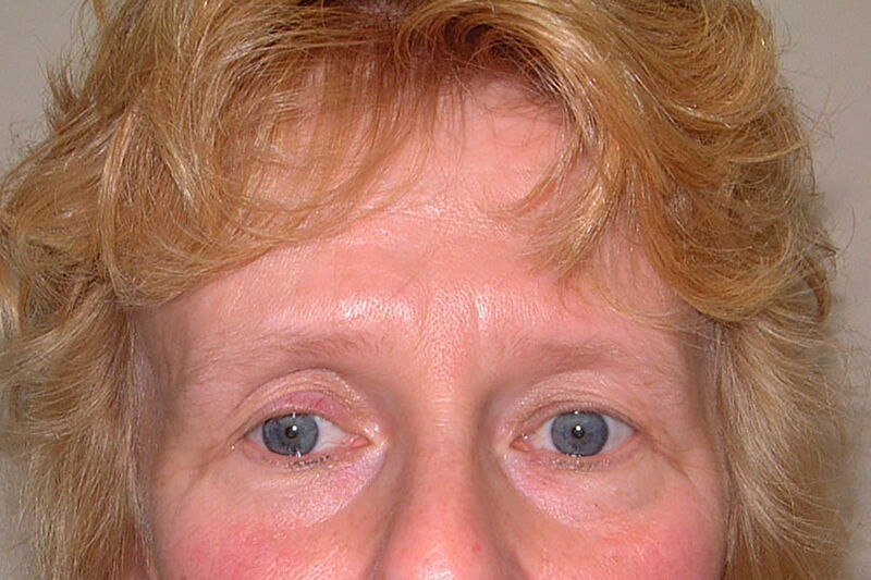 Brow Lift Before & After Patient Photo