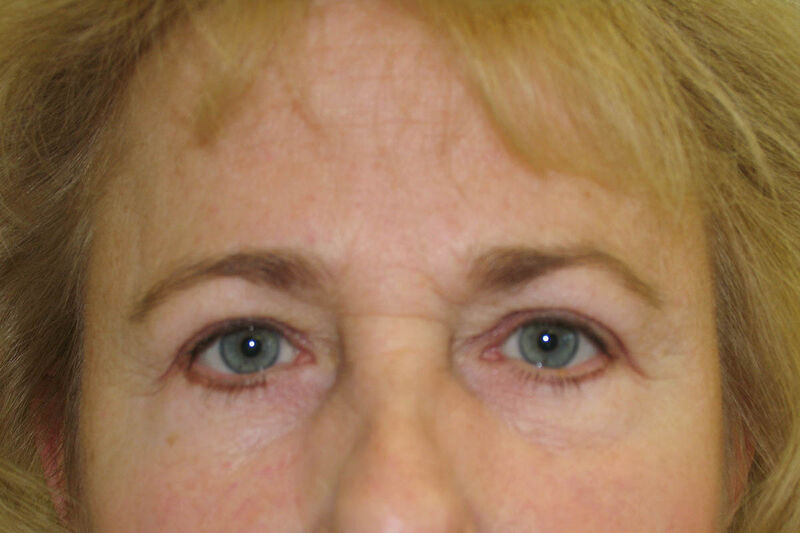 Brow Lift Before & After Patient Photo