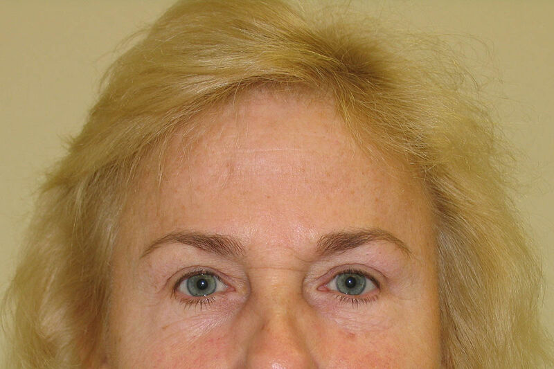 Brow Lift Before & After Patient Photo