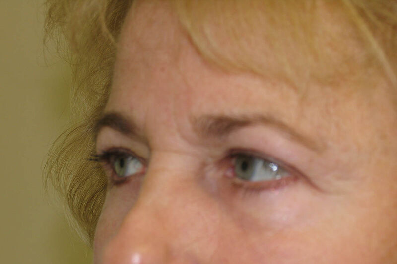 Brow Lift Before & After Patient Photo