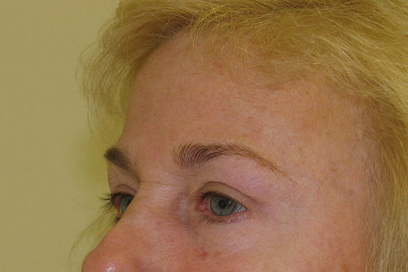 Brow Lift Before & After Patient Photo