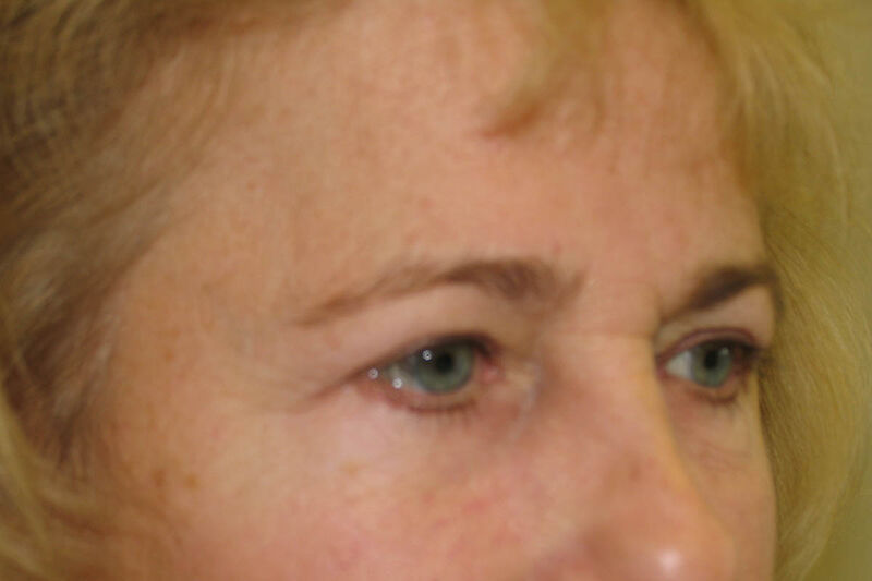 Brow Lift Before & After Patient Photo