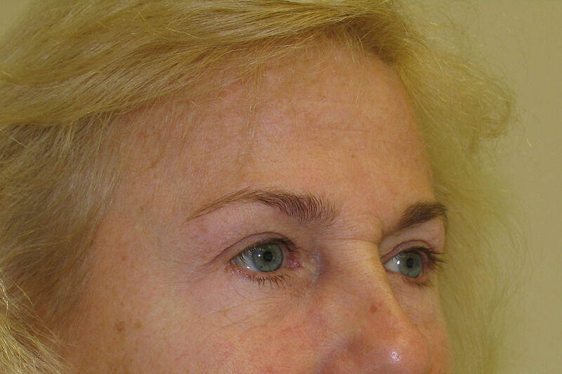 Brow Lift Before & After Patient Photo