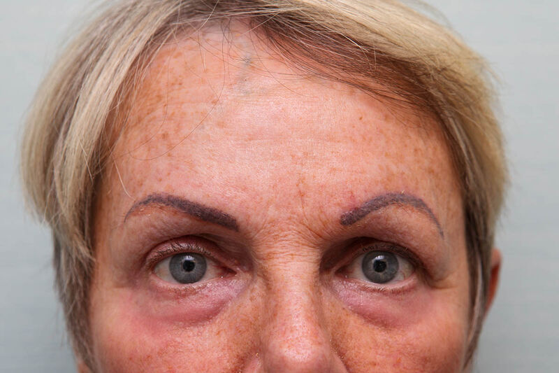 Brow Lift Before & After Patient Photo