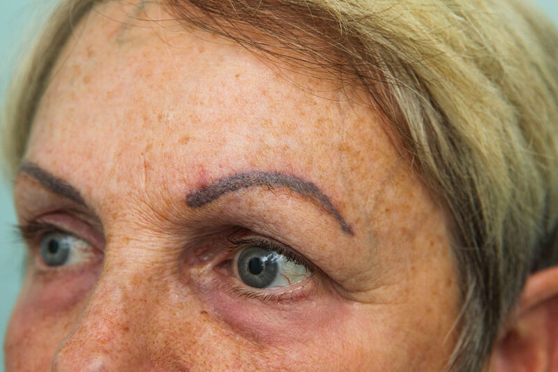 Brow Lift Before & After Patient Photo