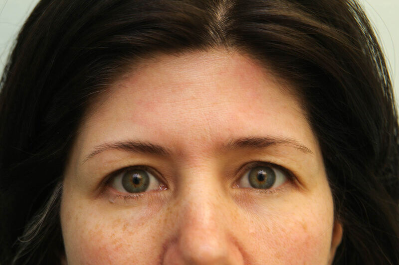 Brow Lift Before & After Patient Photo