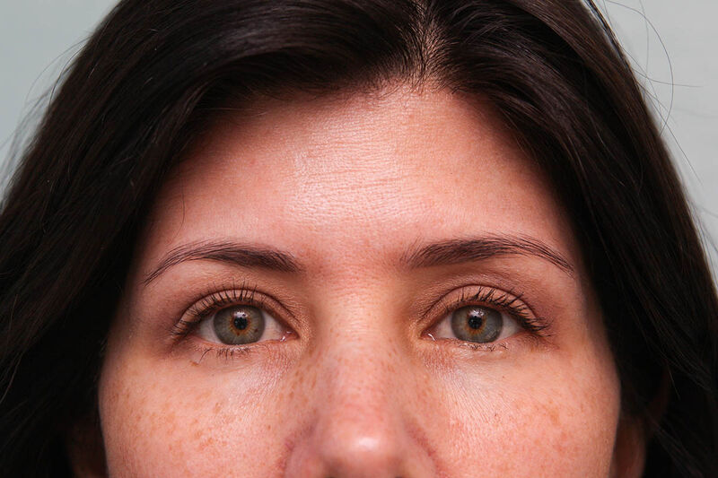 Brow Lift Before & After Patient Photo