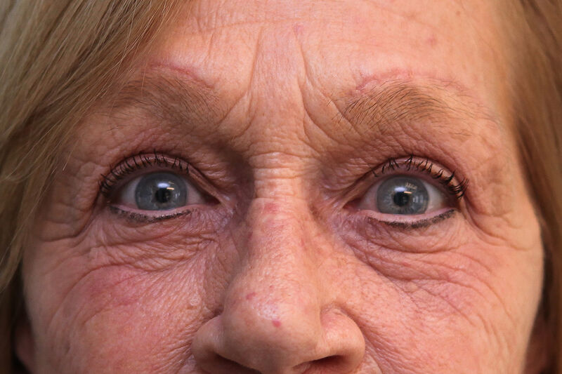 Brow Lift Before & After Patient Photo