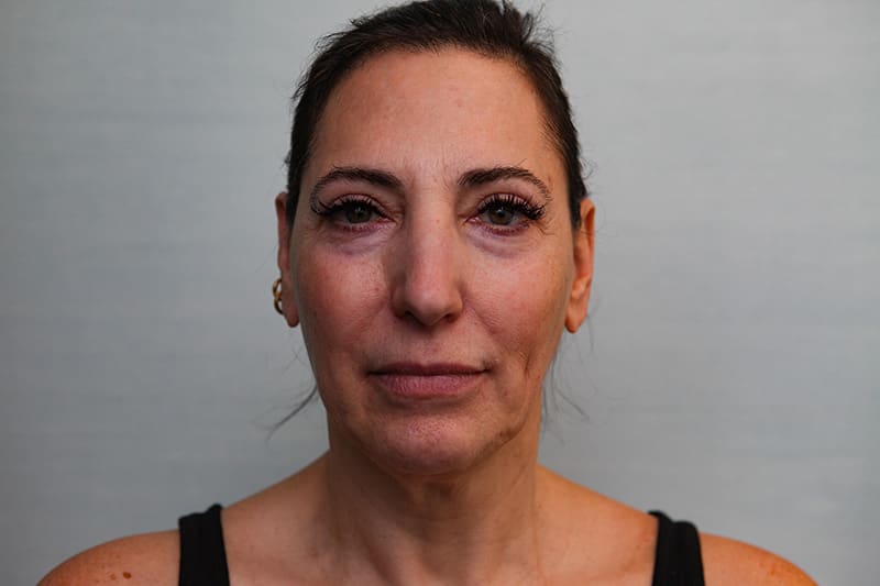 Facelift Before & After Patient Photo