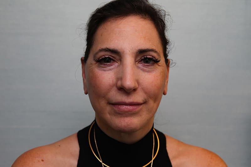 Facelift Before & After Patient Photo