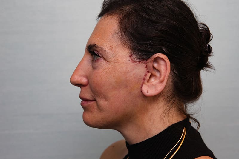 Facelift Before & After Patient Photo