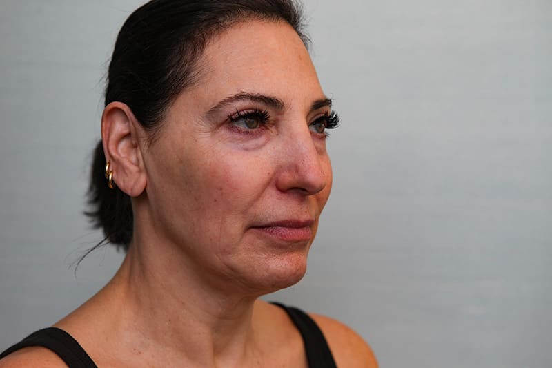 Facelift Before & After Patient Photo