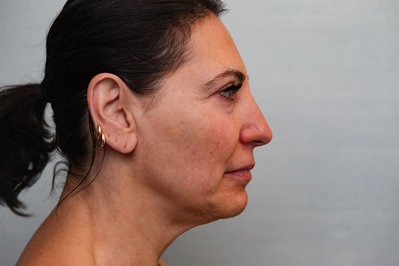 Facelift Before & After Patient Photo