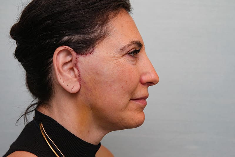 Facelift Before & After Patient Photo