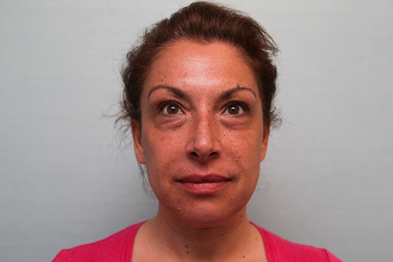 Facelift Before & After Patient Photo