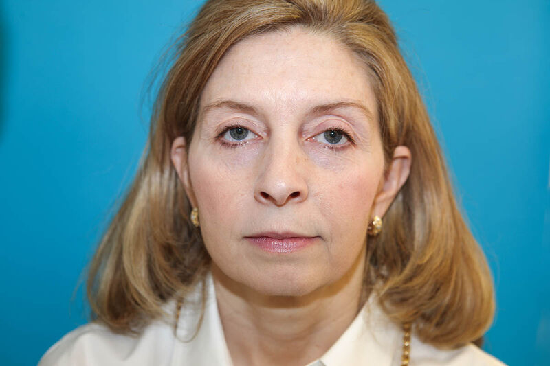 Facelift Before & After Patient Photo