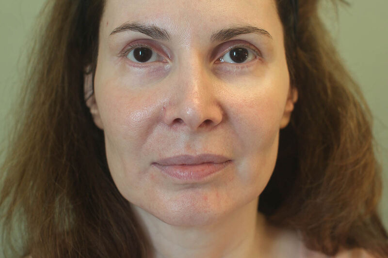 Facelift Before & After Patient Photo