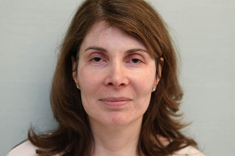 Facelift Before & After Patient Photo