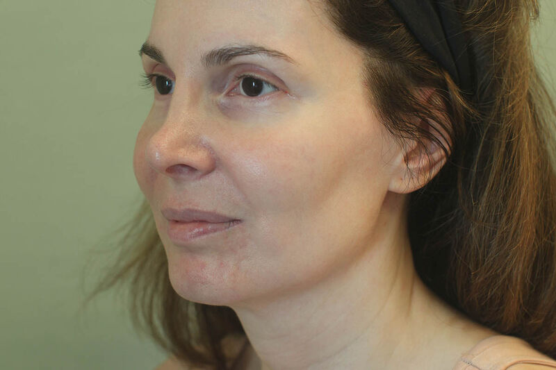 Facelift Before & After Patient Photo