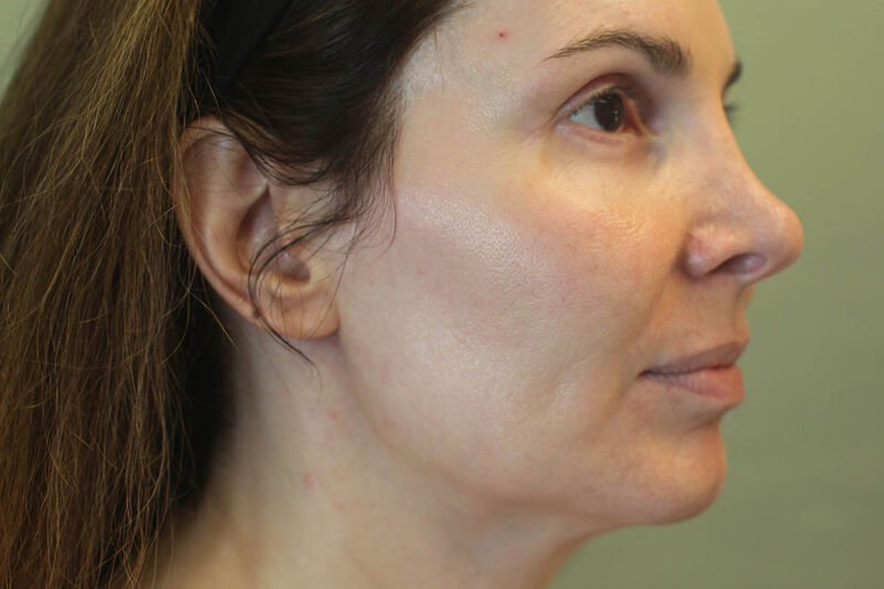 Facelift Before & After Patient Photo