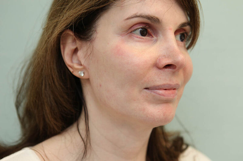 Facelift Before & After Patient Photo