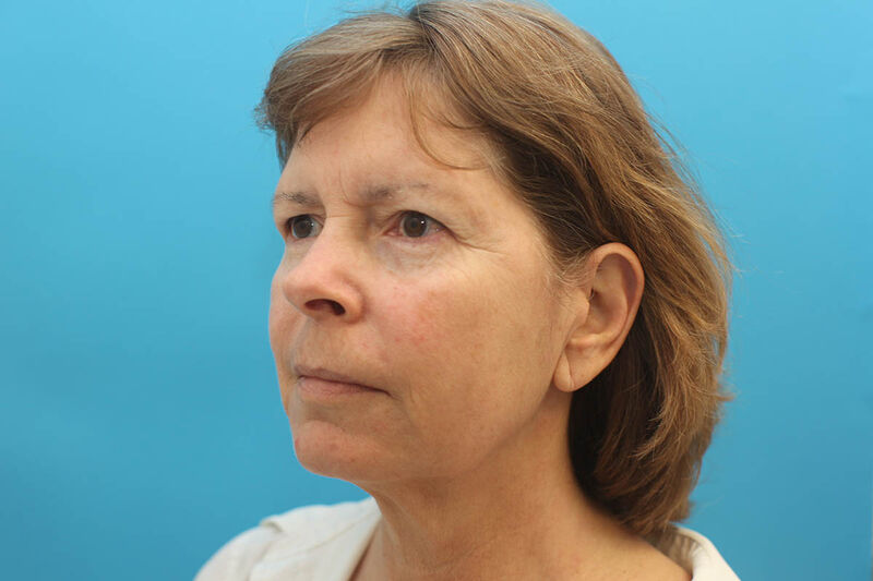 Facelift Before & After Patient Photo