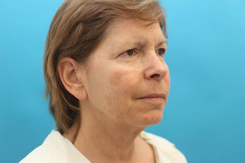 Facelift Before & After Patient Photo