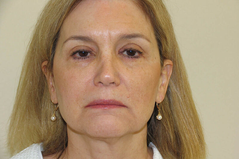 Facelift Before & After Patient Photo