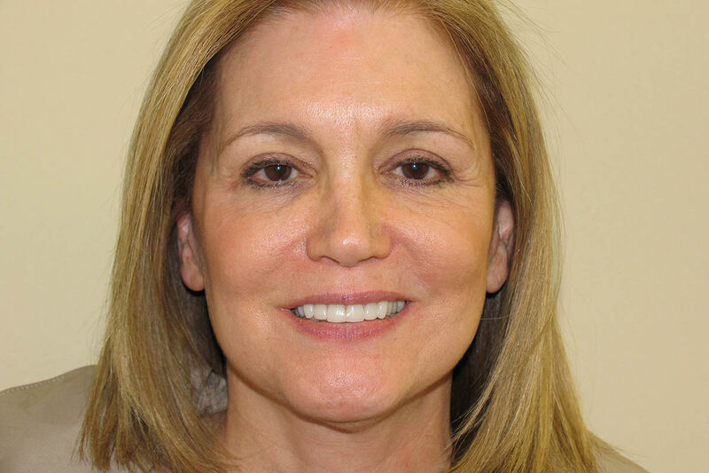 Facelift Before & After Patient Photo