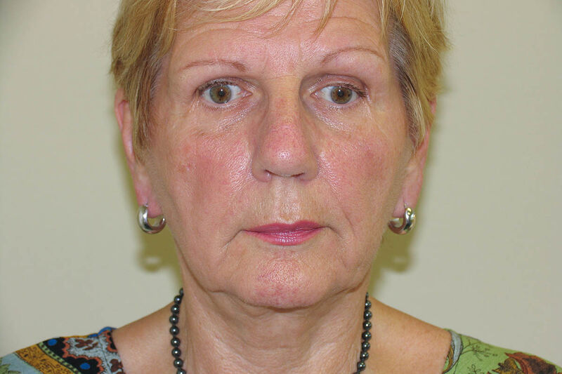 Facelift Before & After Patient Photo