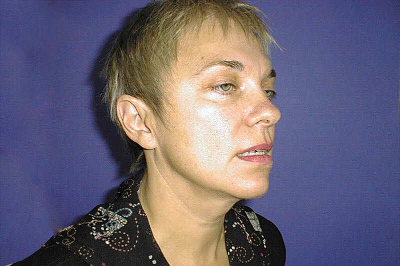 Facelift Before & After Patient Photo