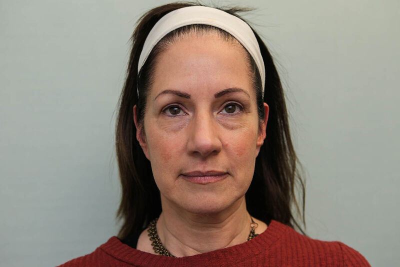 Facelift Before & After Patient Photo