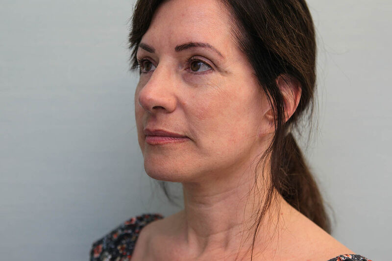 Facelift Before & After Patient Photo