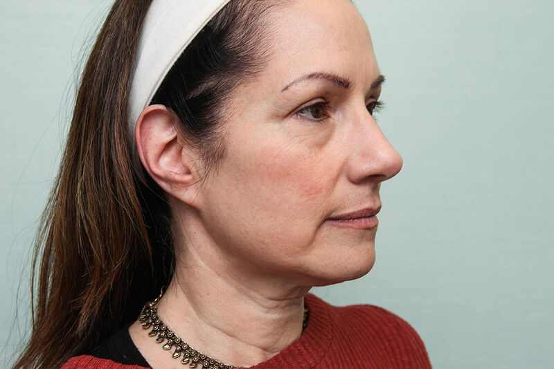 Facelift Before & After Patient Photo